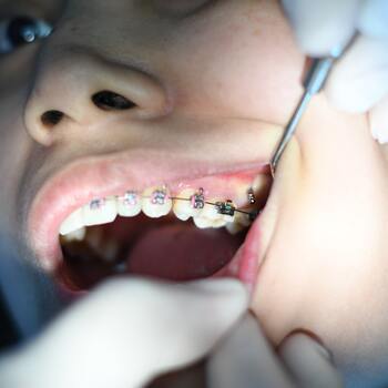 Pénurie en vue chez les orthodontistes